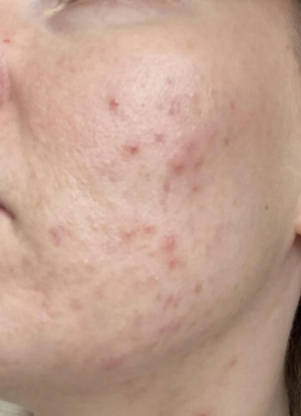 Aura Vellea™ Masque LED Anti-Imperfections