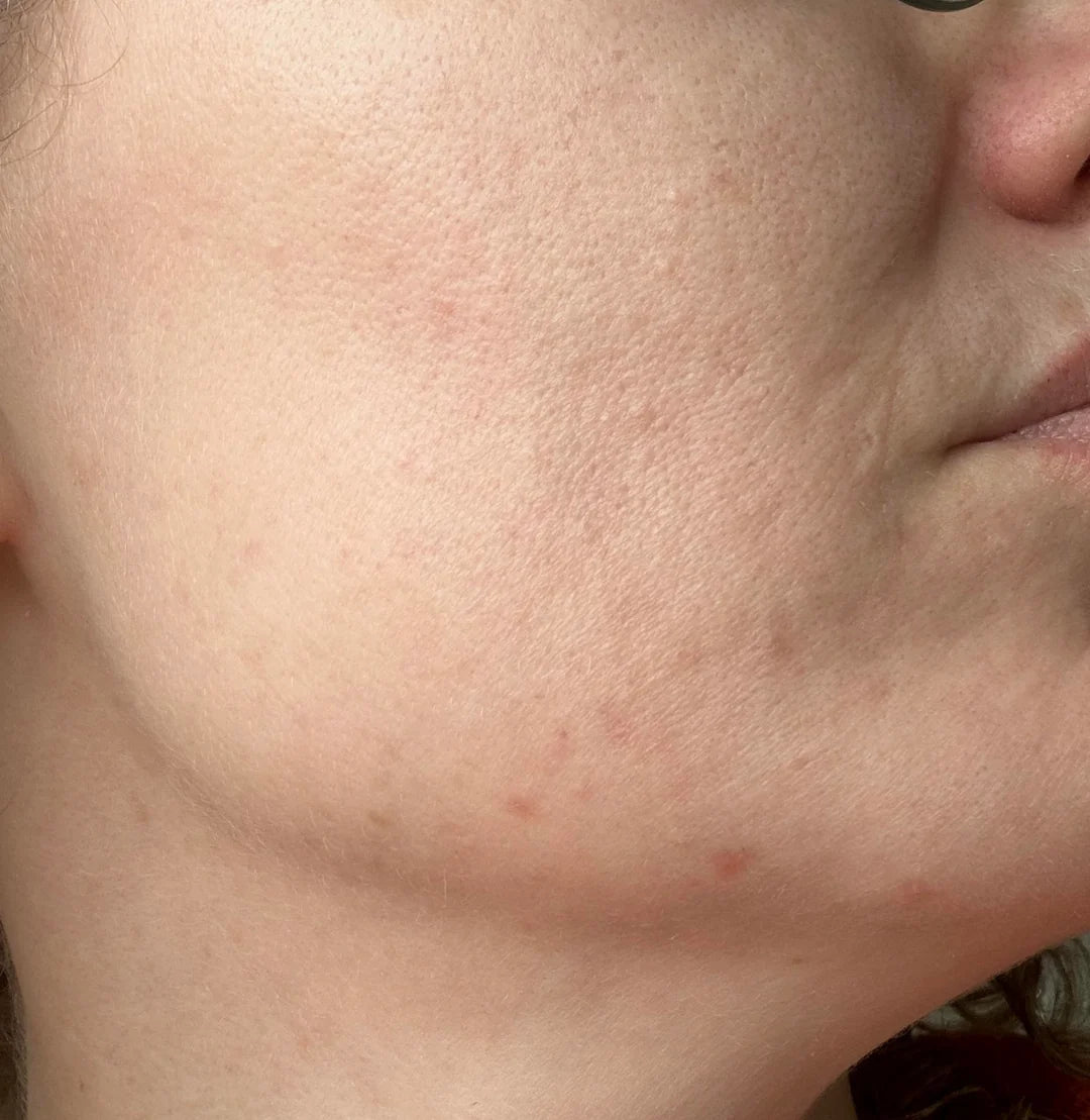 Aura Vellea™ Masque LED Anti-Imperfections