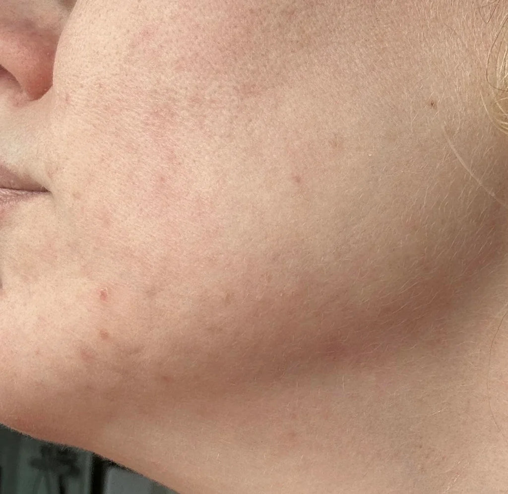 Aura Vellea™ Masque LED Anti-Imperfections